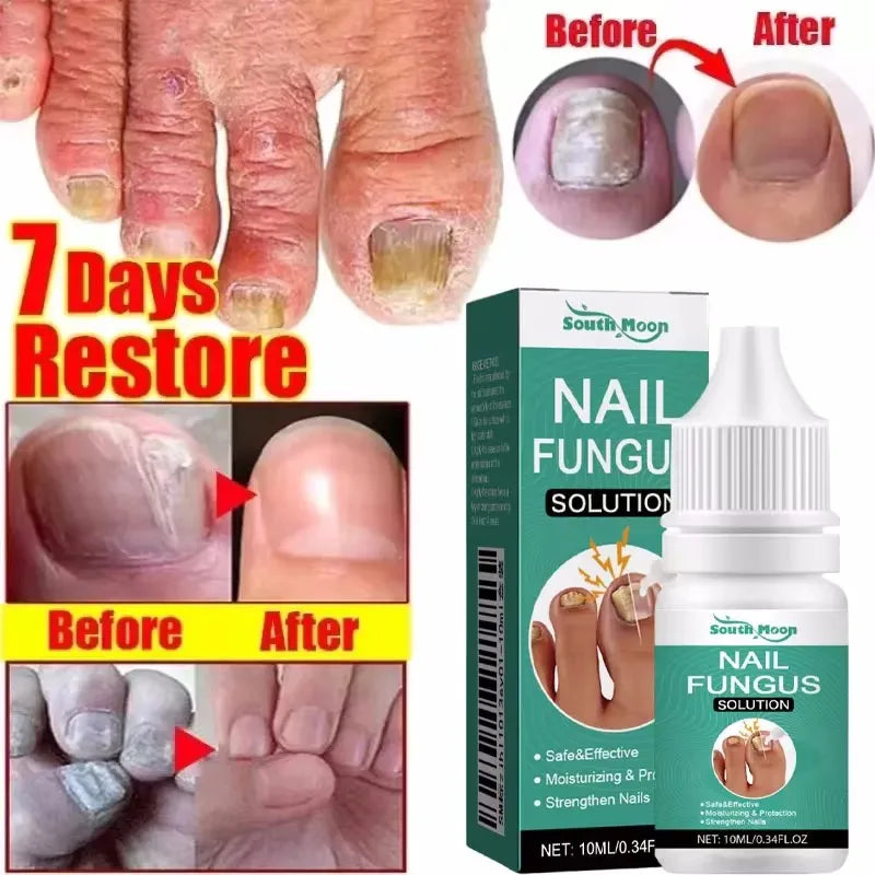 Fungal Nail Treatment Serum 7 Days Fungus Removal Treating Paronychia Liquid Anti Gray Nails Infection Foot Repair Care Tools
