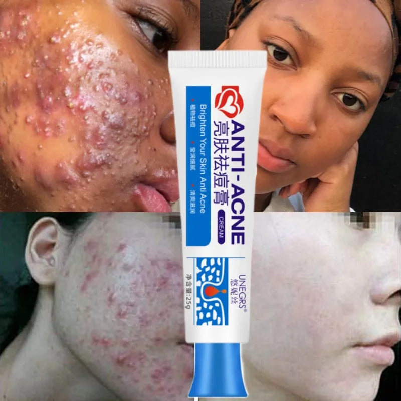 Herbal Acne Removal Face Cream Clears Pimple Scar Black Dots Gel Acne Treatment Shrink Pore Skin Whitening Lightening Ointment