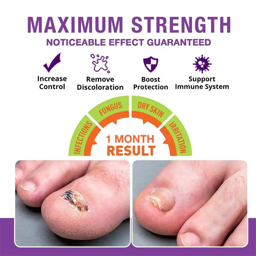 Fungal Nail Treatment Serum Nails Fungus Removal Treating Paronychia Liquid Anti Gray Nails Toe Infection Foot Repair Care Tools