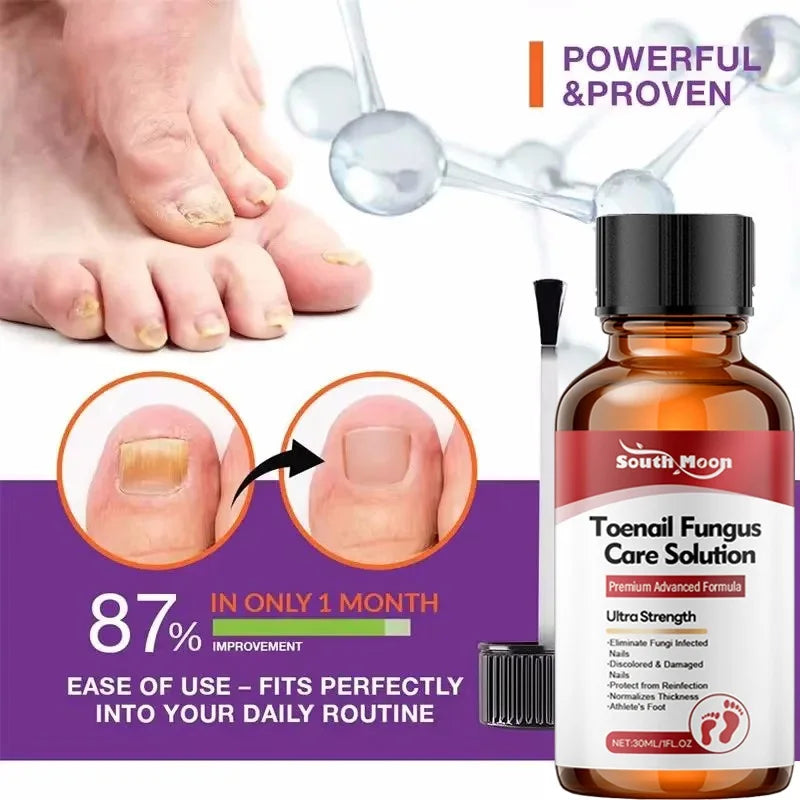 Fungal Nail Treatment Serum Nails Fungus Removal Treating Paronychia Liquid Anti Gray Nails Toe Infection Foot Repair Care Tools