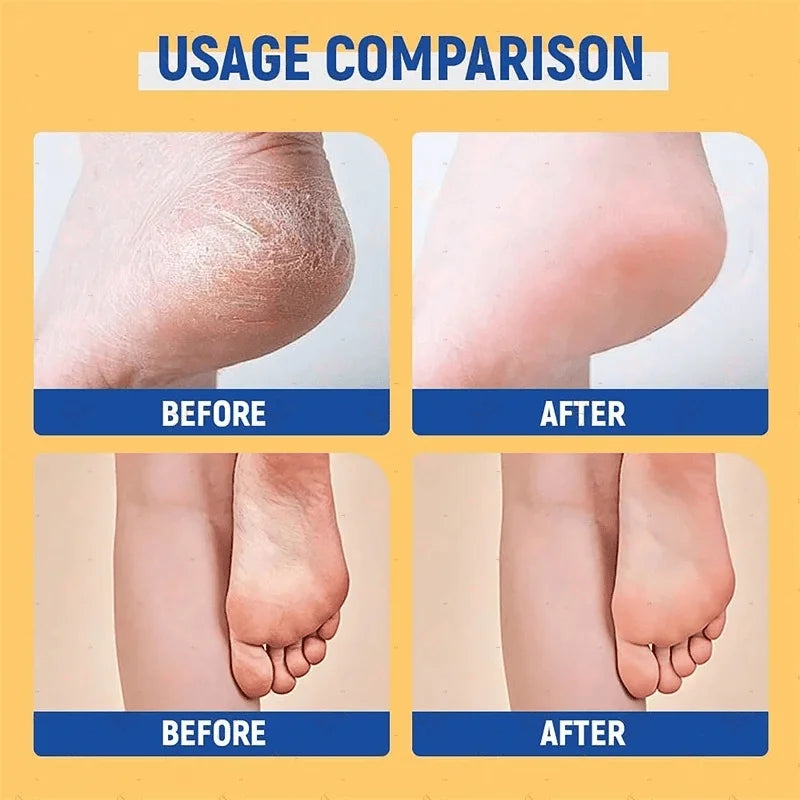 60% Urea Foot Cream Stick - Intensive Moisturizing Exfoliating, Cracked Heel Repair & Deep Hydration for Dry Rough Feet, Long-La