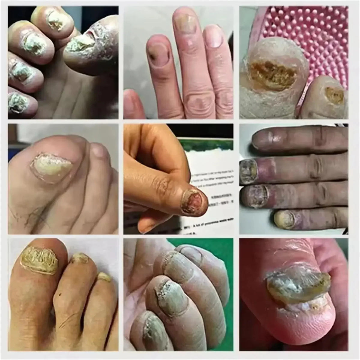 7 Days Fungal Nail Treatment Serum Foot Nail Fungus Removal Repair Gel Anti Infection Paronychia Onychomycosis Foot Nails Care