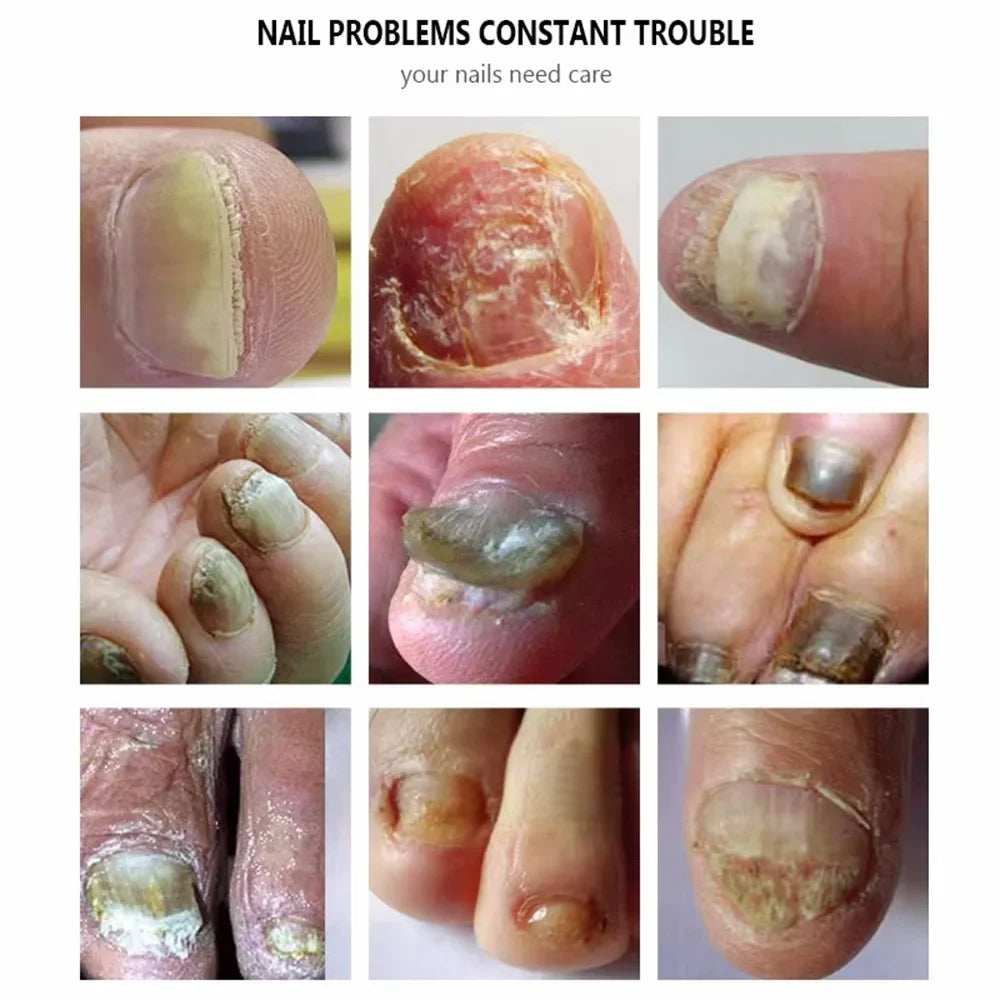 Fungal Nail Treatment Serum Nails Fungus Removal Treating Paronychia Liquid Anti Gray Nails Toe Infection Foot Repair Care Tools