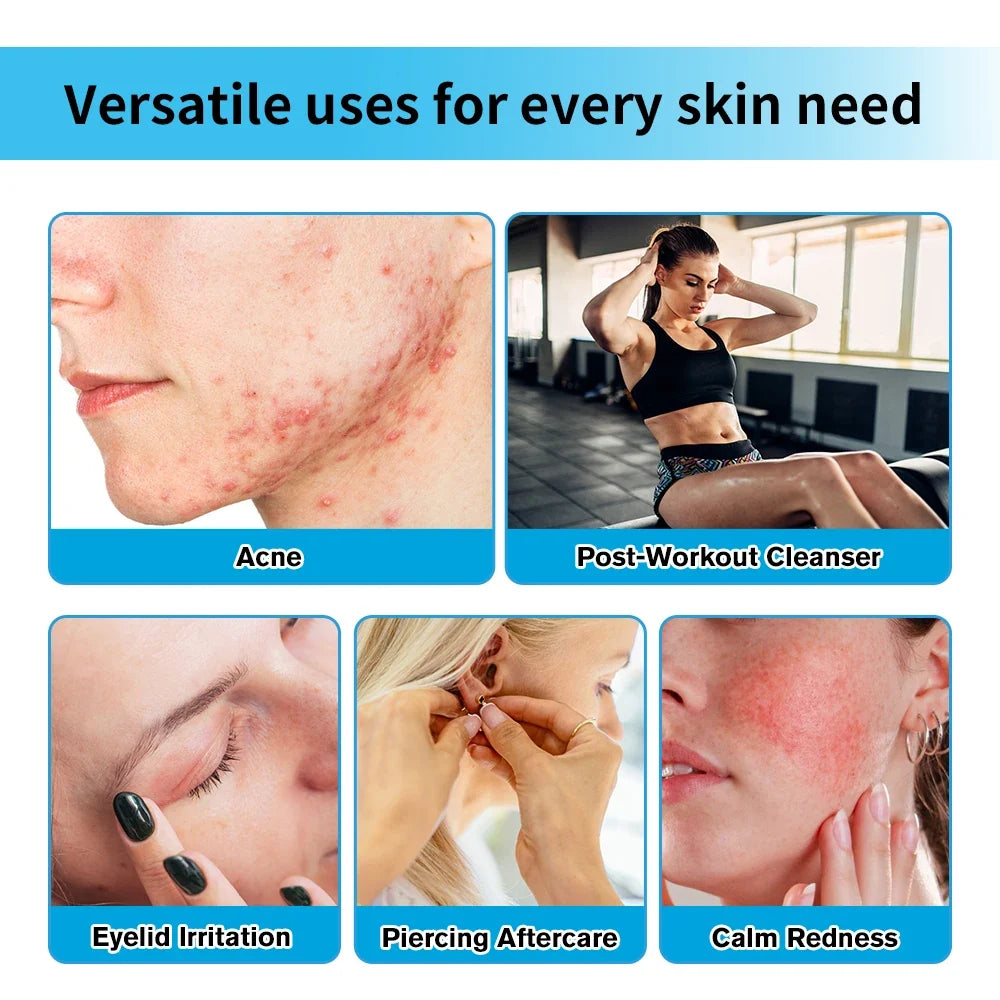 Hypochlorous Acid Facial Spray Reduce redness swelling acne Versatile uses for every skin Calm Redness Eyelid lrritation Care Sk