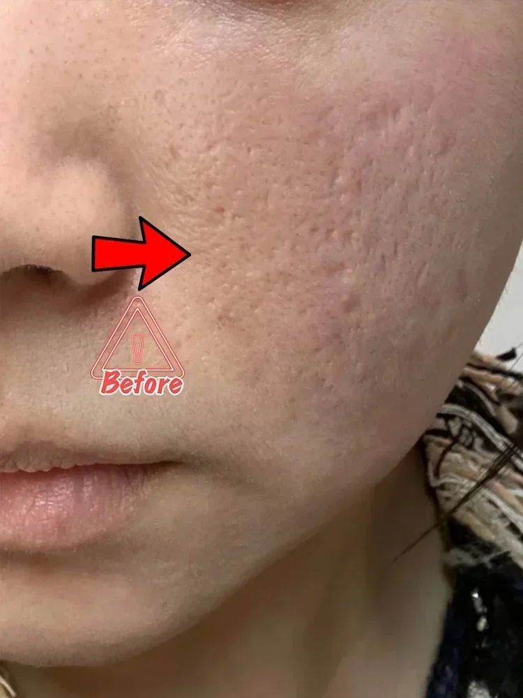 Anti-acne mark pothole Repair Men's Hole Repair Cream Fade to remove acne mark scar fade fill regeneration gel