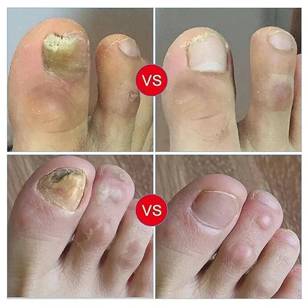 Fungal Nail Treatment Serum Nails Fungus Removal Treating Paronychia Liquid Anti Gray Nails Toe Infection Foot Repair Care Tools