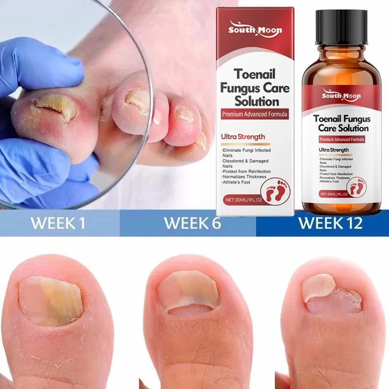 Fungal Nail Treatment Serum Nails Fungus Removal Treating Paronychia Liquid Anti Gray Nails Toe Infection Foot Repair Care Tools