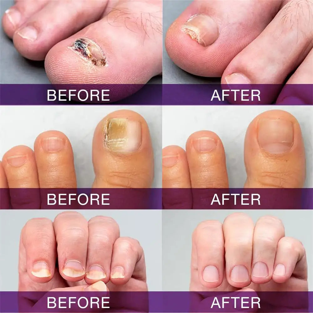 Fungal Nail Treatment Serum Nails Fungus Removal Treating Paronychia Liquid Anti Gray Nails Toe Infection Foot Repair Care Tools