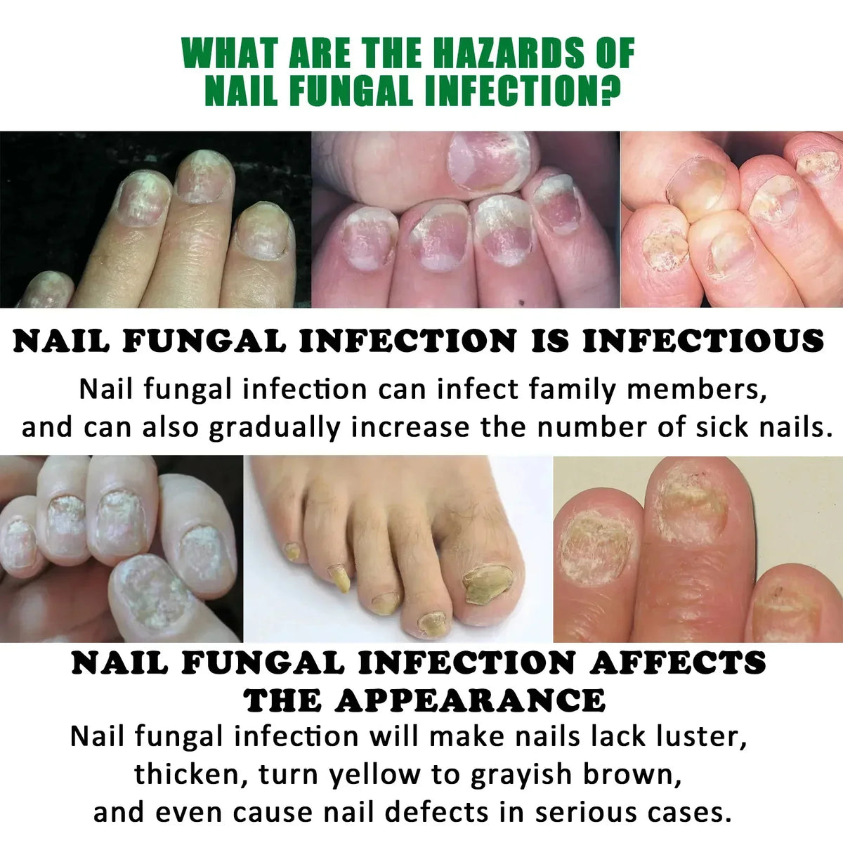 7 Days Fungal Nail Treatment Serum Foot Nail Fungus Removal Repair Gel Anti Infection Paronychia Onychomycosis Foot Nails Care