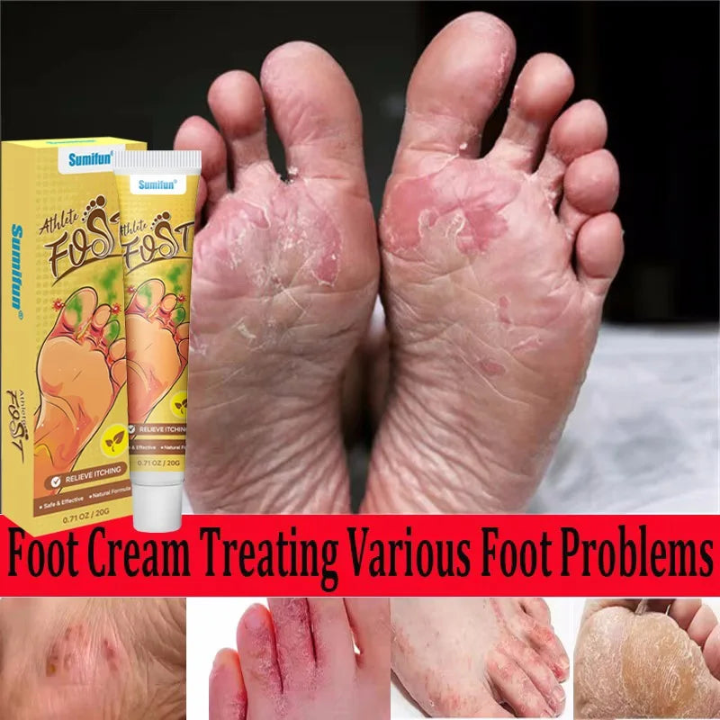 Anti-Foot Fungus Ointment Deodorant Care Products Foot Deodorant Creams Antiseptic and Antiperspirant Foot Skin Topical Cream