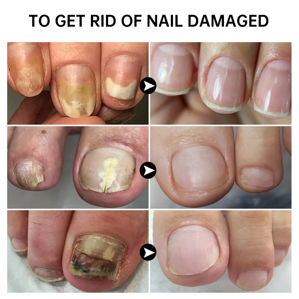 7 Days Fungal Nail Treatment Serum Foot Nail Fungus Removal Repair Gel Anti Infection Paronychia Onychomycosis Foot Nails Care
