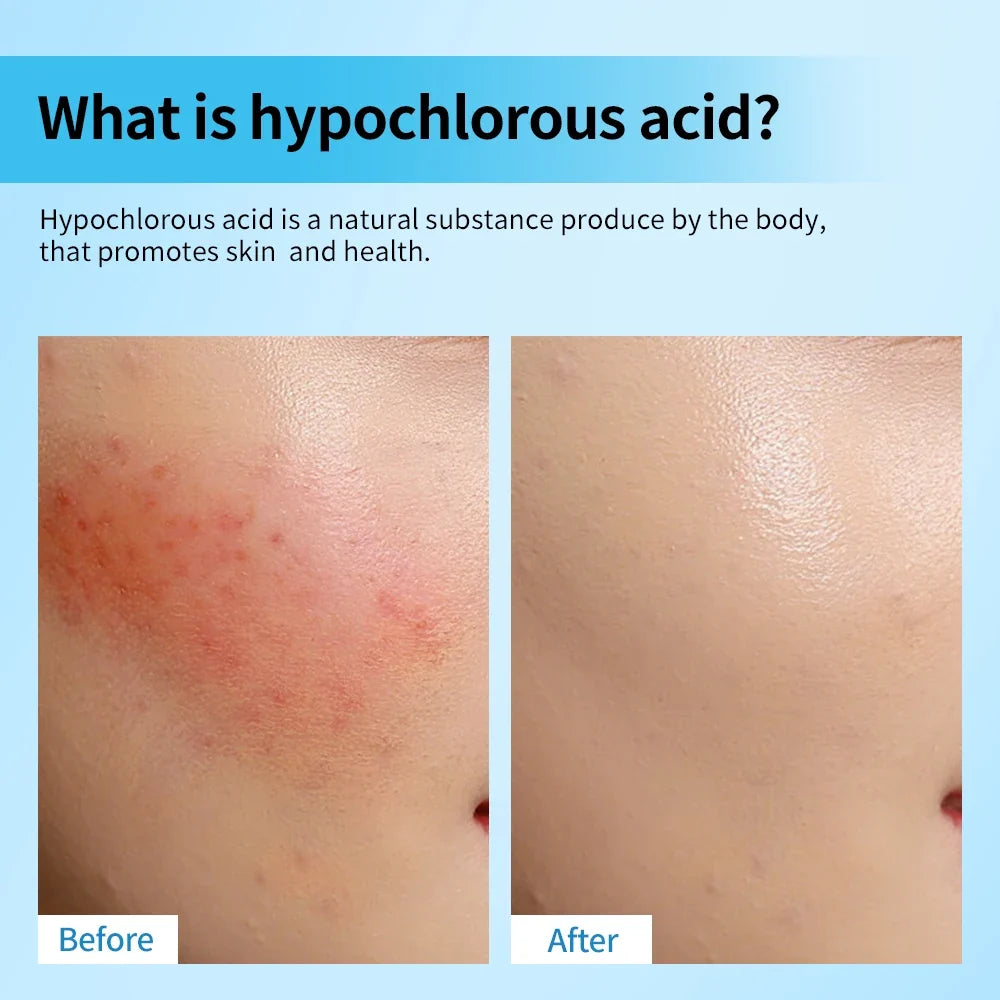 Hypochlorous Acid Facial Spray Reduce redness swelling acne Versatile uses for every skin Calm Redness Eyelid lrritation Care Sk