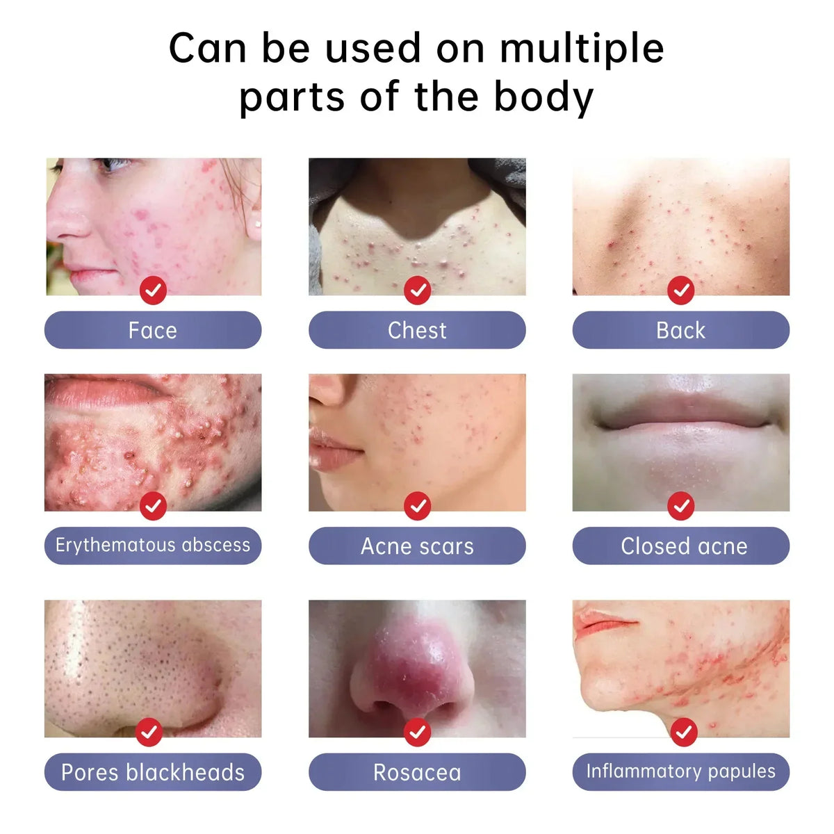 Herbal Acne Removal Face Cream Clears Pimple Scar Black Dots Gel Acne Treatment Shrink Pore Skin Whitening Lightening Ointment