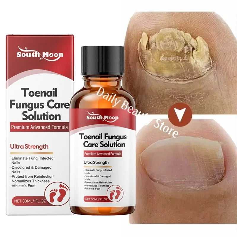 Fungal Nail Treatment Serum Nails Fungus Removal Treating Paronychia Liquid Anti Gray Nails Toe Infection Foot Repair Care Tools