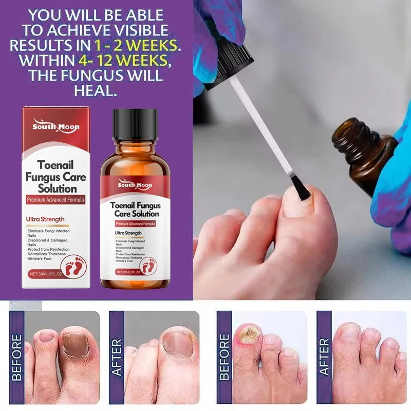 Fungal Nail Treatment Serum Nails Fungus Removal Treating Paronychia Liquid Anti Gray Nails Toe Infection Foot Repair Care Tools
